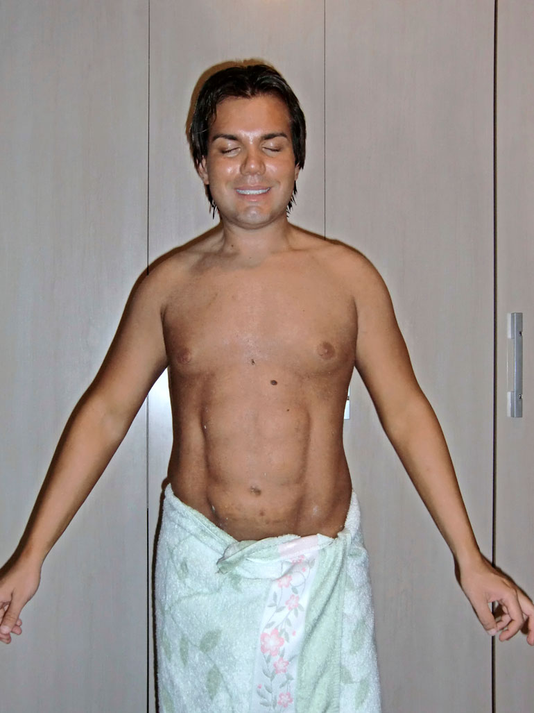 Rodrigo hankki vatsalihaksia muistuttavat implantit useita vuosia sitten.